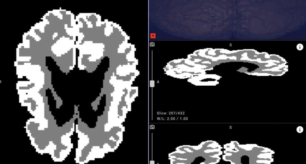 Белорусские врачи смогут точнее выявлять ДЦП у новорожденных с помощью нейросети Яндекса