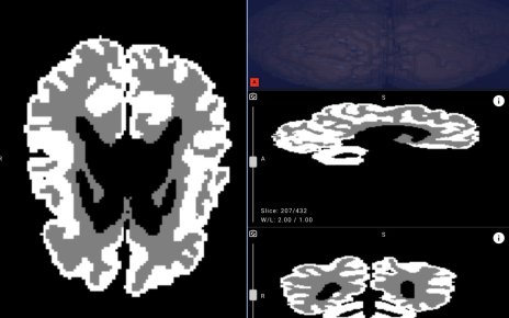 Белорусские врачи смогут точнее выявлять ДЦП у новорожденных с помощью нейросети Яндекса